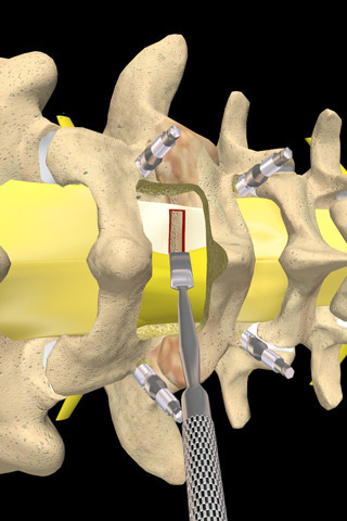 椎间融合器置入前路三节段椎间盘切除修复颈椎病