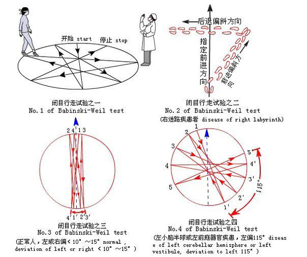 闭目行走试验行走试验变位性眼震检查法闭目难立征眼震检查指指试验