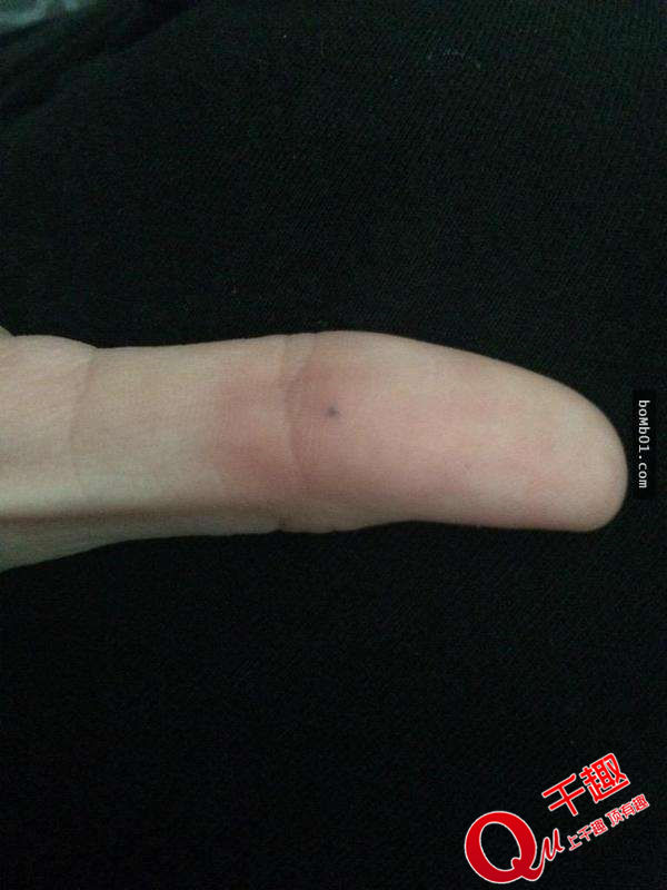 手指上黑点是癌症信号图片