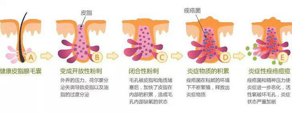 痘痘肌肤形成根本原因及根本解决办法