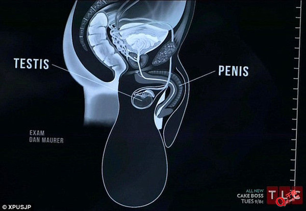 睾丸增大 男性图片