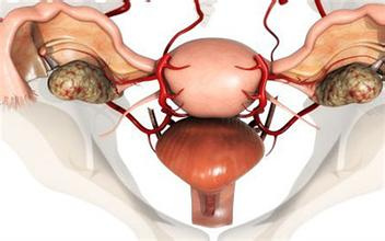 2,出血性囊腫:濾泡囊腫和黃體囊腫生長的過於迅速,導致卵巢的組織牽扯