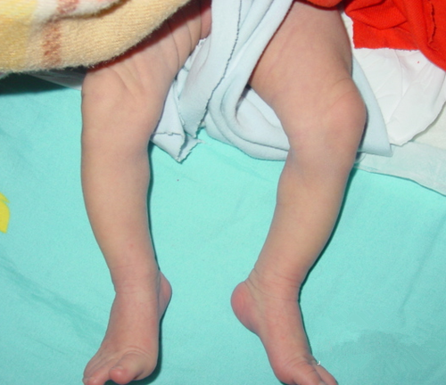 宝宝小腿弯曲的正常图图片
