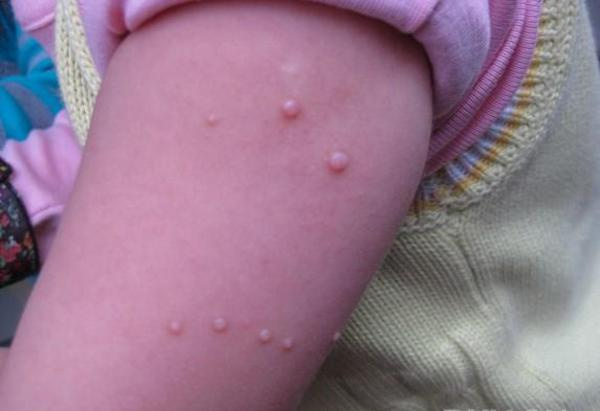 儿童病毒性疣早期图片图片
