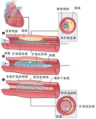 冠脉尿激酶溶栓及支架植入对急性心梗影响