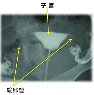 首先就是x光下的输卵管造影技术