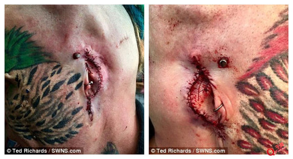 纹身植皮手术恢复图片