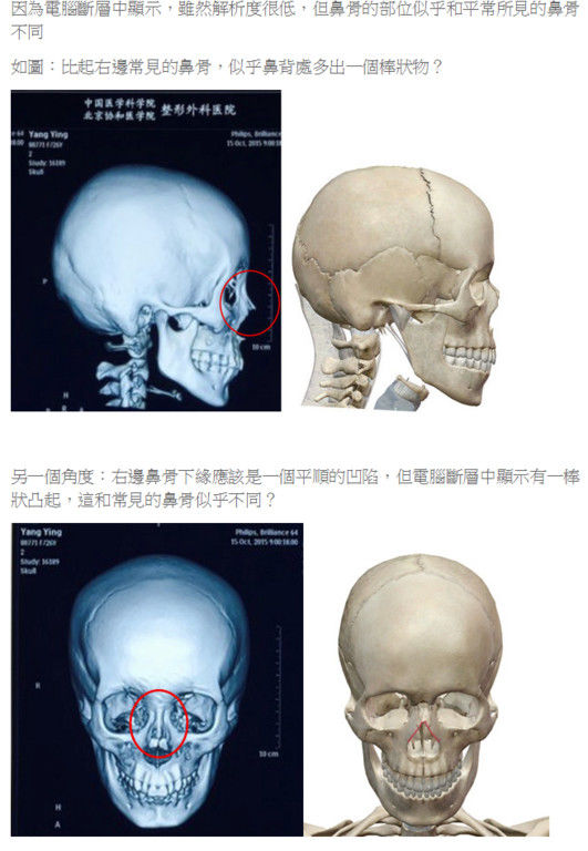 臺灣專家質疑楊穎面部鑑定結果:鼻骨有棒狀物-搜狐