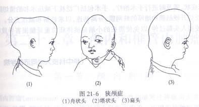 形成舟状头或长头畸形;(1)所有颅缝均过早闭合,形成尖头畸形或塔状头