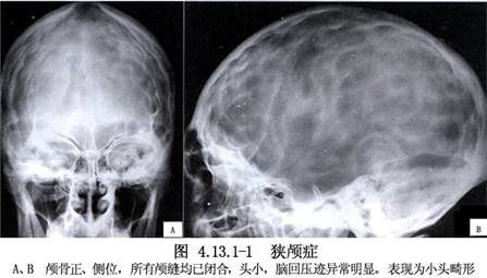 三,鉴别诊断需与先天性脑发育不全所致的小头畸形相鉴别,后者的头颅