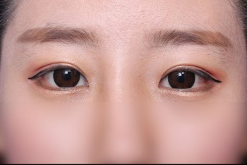 常见的双眼皮整形手术方法