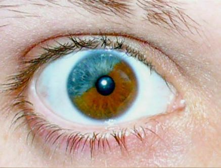 异色虹膜综合症图片