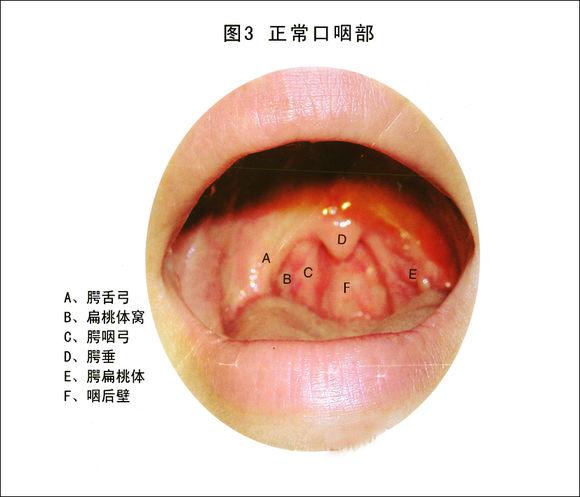 慢性咽炎照片图片