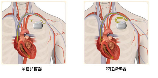 起搏器植入术过程图解图片