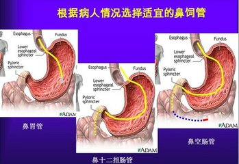 空肠营养管结构图图片