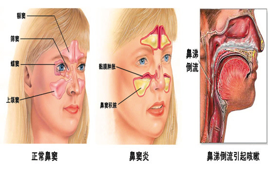 如果醫生檢查口咽,經常會發現孩子的咽後壁濾泡明顯增生,就像鵝卵石