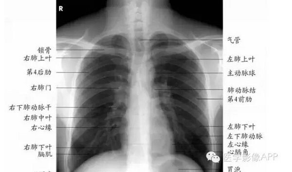 正常x光胸片图片图解图片