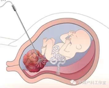 是应用超声定位后用直径很细的光学纤维内镜经母体腹壁穿刺,经子宫壁