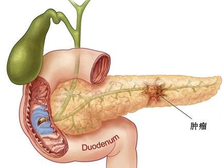 胰腺假性囊腫手術治療方法