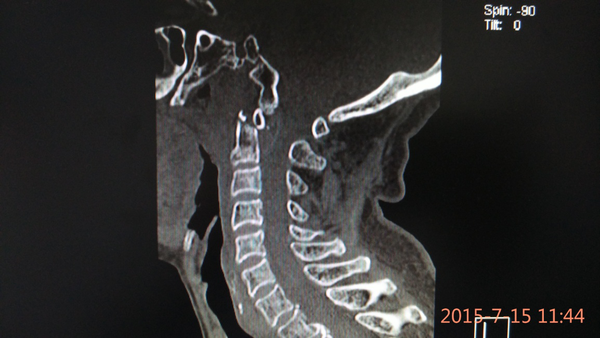 枢椎齿状突骨折枢椎前滑脱