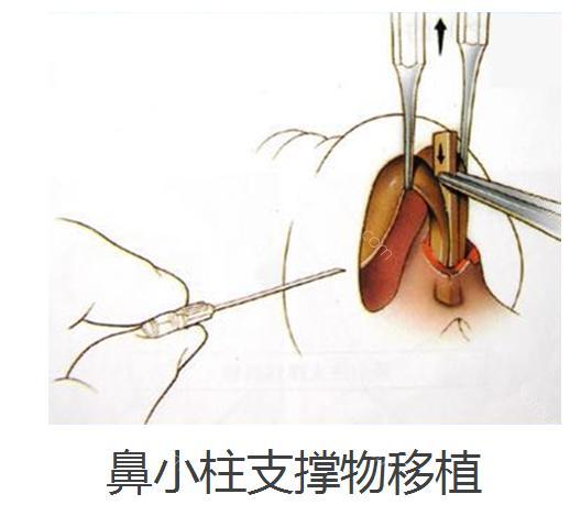 鼻小柱延长是怎么做的图片