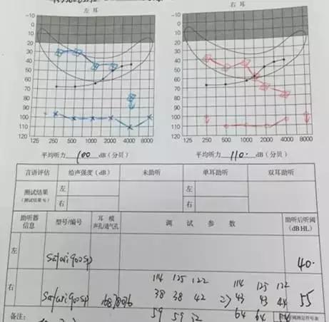 極重度聽力損失,助聽器會有用嗎?