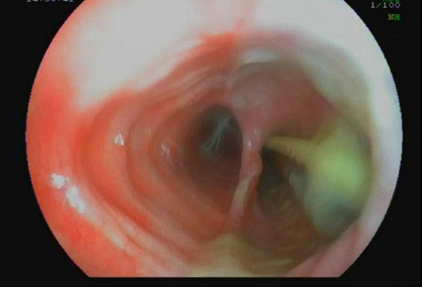 入院后纤维支气管镜检查见瘘口位于声门下3cm,自第二气管环下至至第六