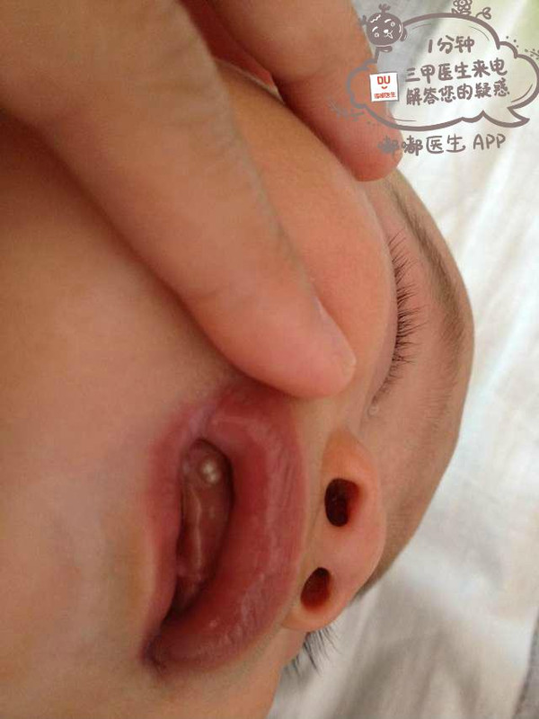 宝宝出牙前牙龈图片图片