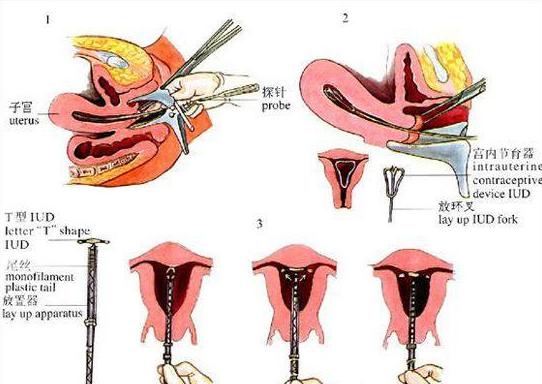 你只能去医院放置宫内节育环了