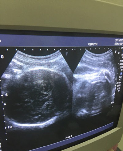 怀孕50天左右b超图片图片