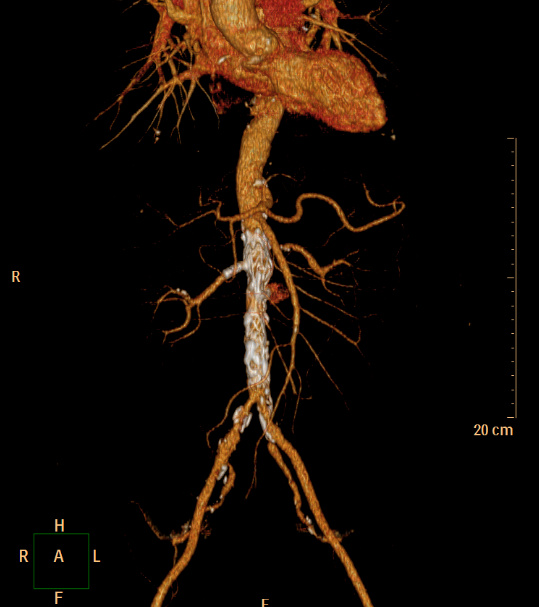 戈尔支架开窗治疗1例近肾腹主动脉瘤报告