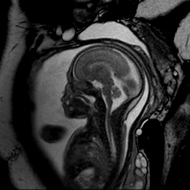 胎儿睾丸正常磁共振图图片