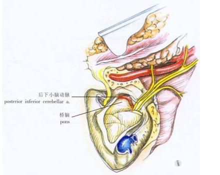 頸靜脈球瘤診治