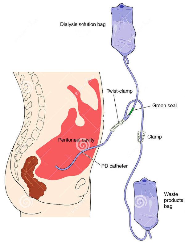 腹膜透析 示意图图片