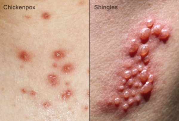 有些朋友可能听说过疥疮,是一种叫疥螨的寄生虫,穿入人体皮肤留下的
