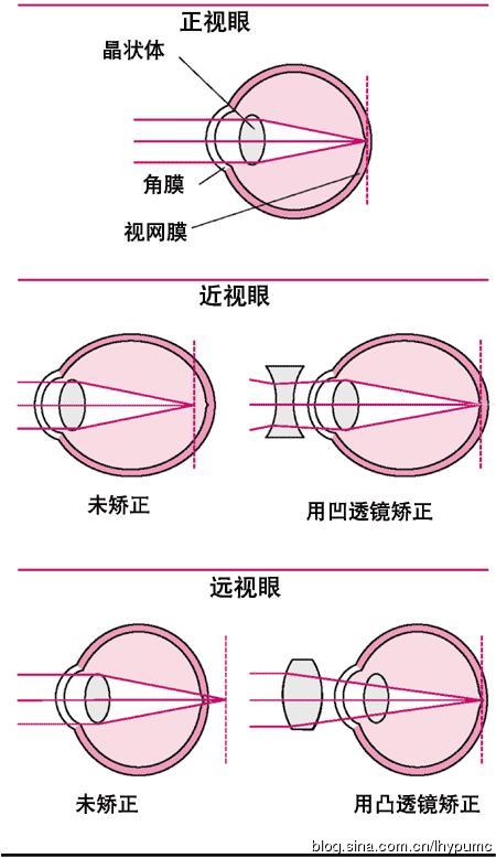 为了矫正近视,就需要把光线聚焦点调节到视网膜黄斑中心凹