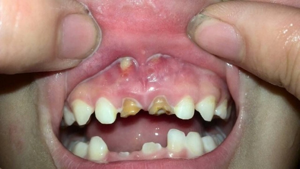 齿状核钙化图片