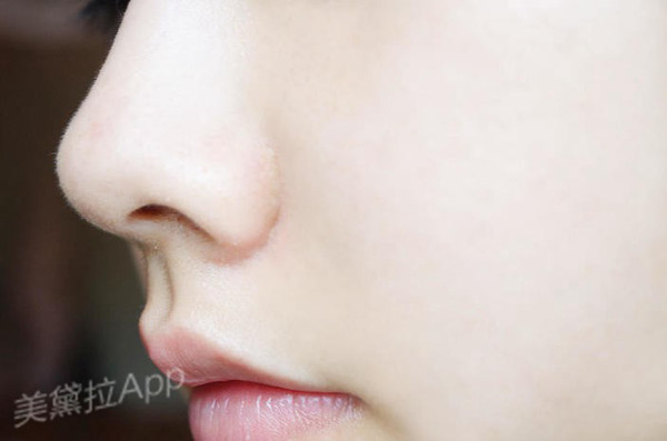 埋线缩鼻翼不着痕迹提升萌妹力