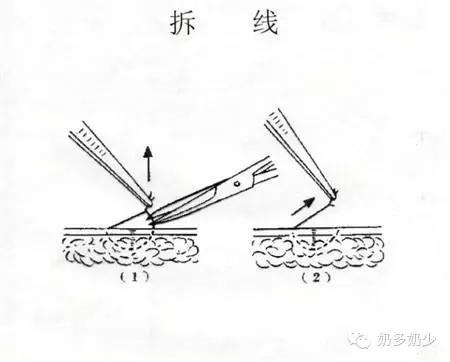 拆线图解图片