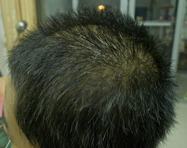 男性随着年龄的增长,脂溢性脱发的发病率亦逐渐增加,脂秃常发于蔬七