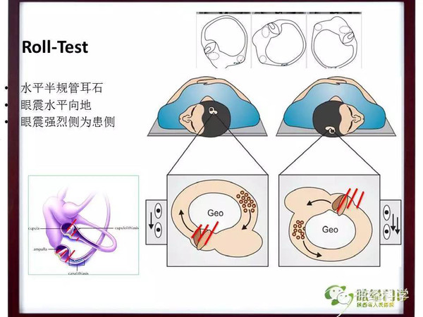 长安眩晕讲堂精品课件良性阵发性位置性眩晕