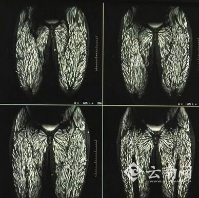 感染 因誤食豬帶絛蟲卵而感染,也可因體內有豬帶絛蟲寄生而自身