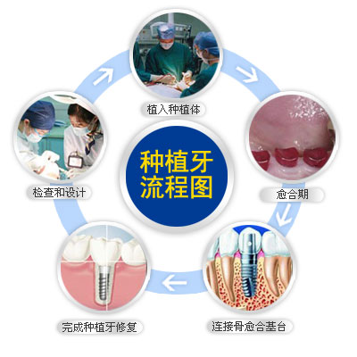 種植牙的過程有哪些種植牙的過程有哪些,種植牙是我們現在牙齒修復中
