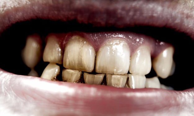 你的牙齿到底有多脏?美国牙医教你自检15招!