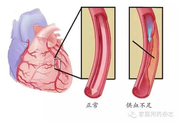 緩解心絞痛,您選對藥了嗎?