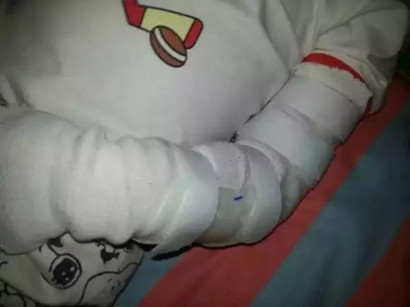 男童幼儿园遭虐待左臂骨折