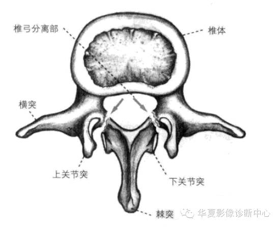 椎弓峡部位置图片