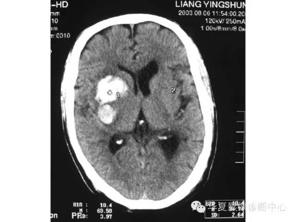 乾貨教學腦內血腫mri表現規律