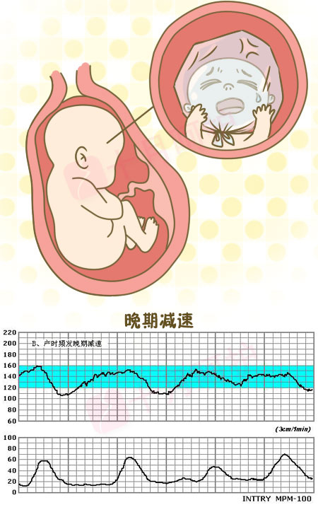 胎心监护图怎么看图片
