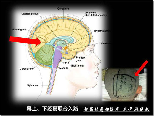 軍醫科普松果體及松果體瘤